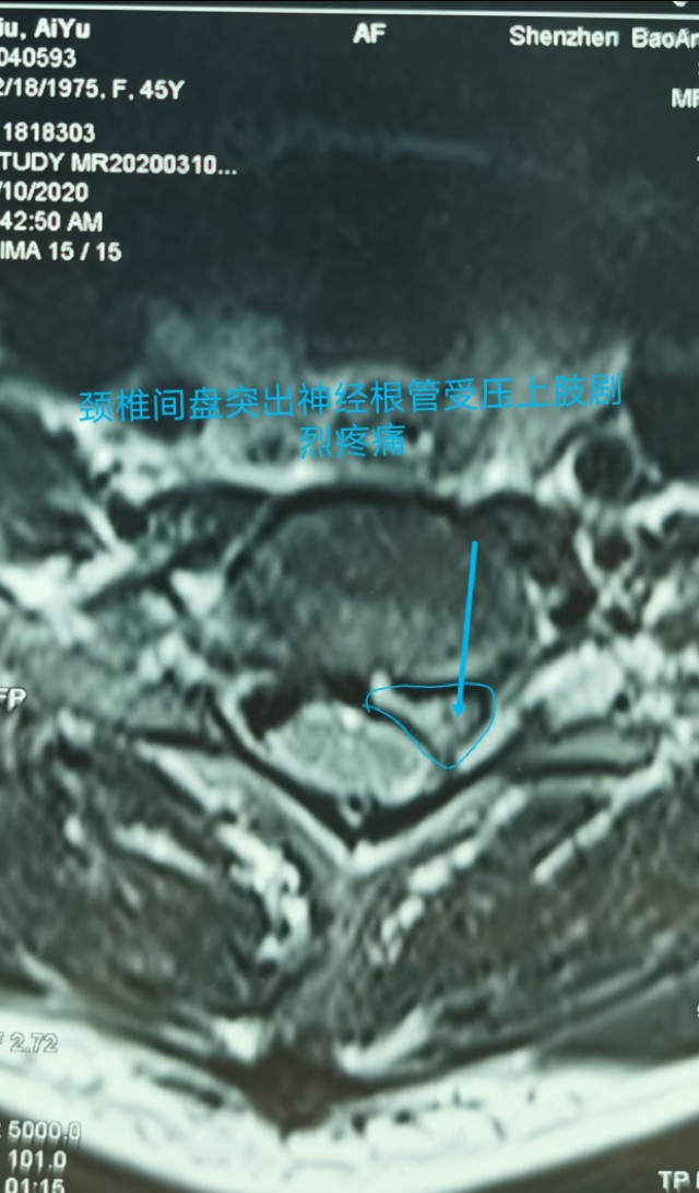 疫情期间颈椎病发作怎么办,疫情间躺久了头昏眼胀怎么治