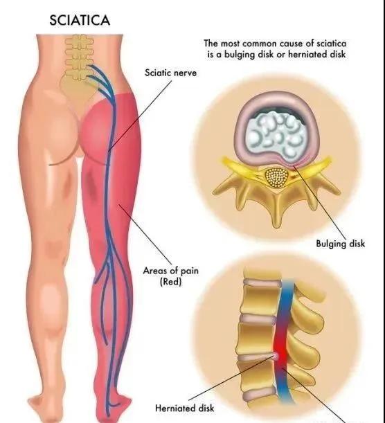 束腰带到底能不能瘦腰,束腰带真的能瘦腰吗