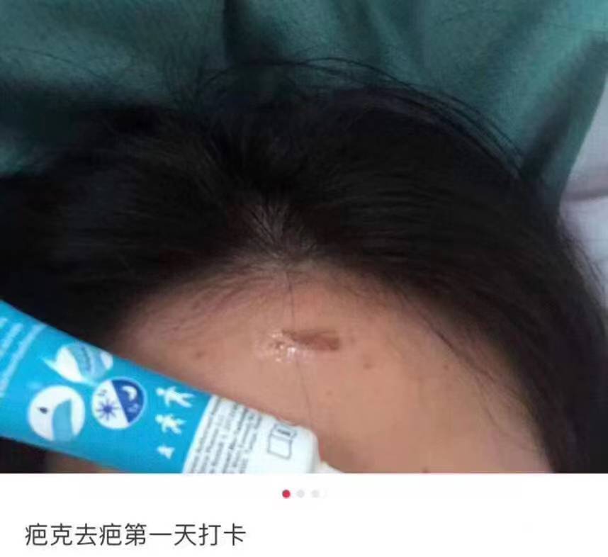 你用过最好的祛疤方法,超好用的祛疤产品