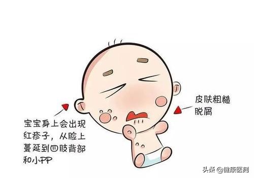婴幼儿湿疹总是反复应该怎么治疗,婴儿湿疹反反复复怎么根除