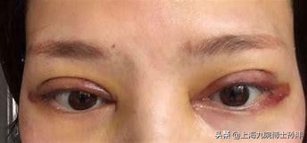 全切双眼皮疤痕增生怎样好得快,全切双眼皮皮下疤痕增生怎么办