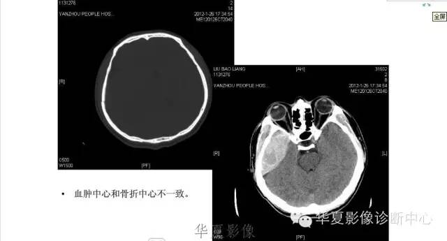 一文读懂颅内胆脂瘤,一文看懂背后的真相