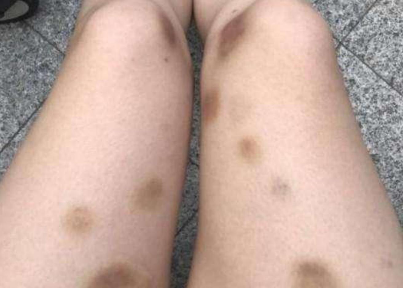 “你怎么下得了手”，妹妹被哥哥掐得浑身是伤，宝妈质问反遭打脸