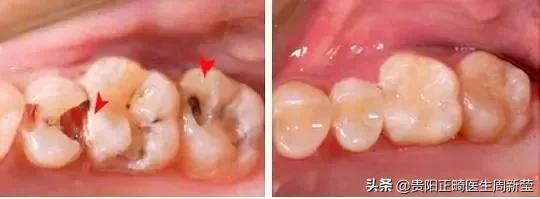 牙疼去看牙需要多久,牙疼的建议