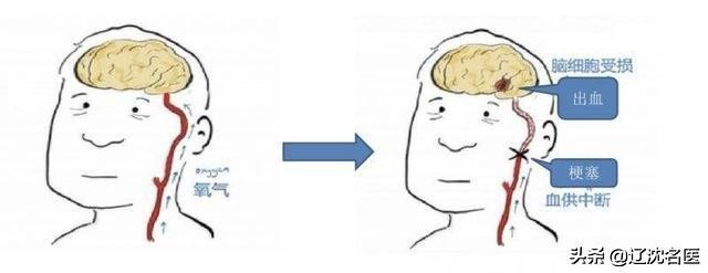 沈阳医大二院手足外科专家,沈阳现代医院治疗偏瘫