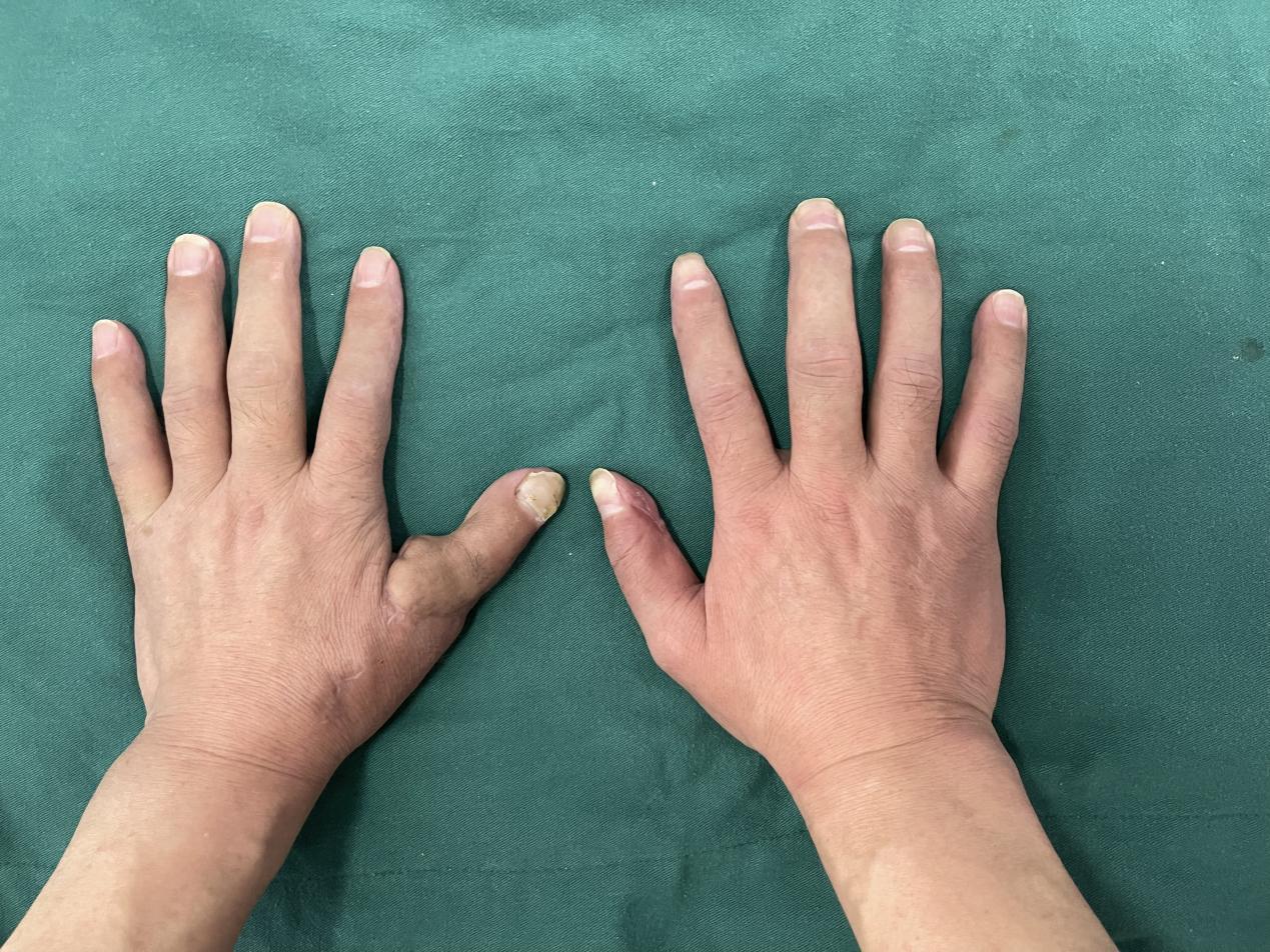 脚趾变手指移花接木,不可思议极限冲刺