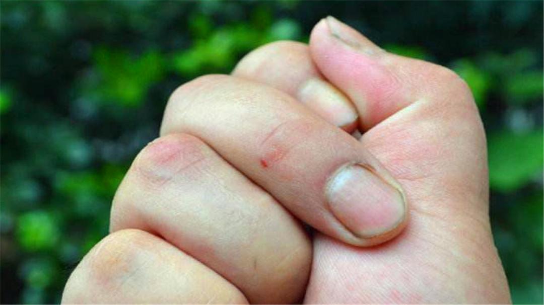 鱼刺扎伤手后感染的是什么菌,干鱼刺扎破手会感染细菌吗