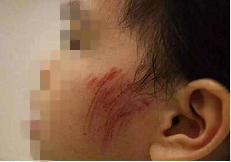 小孩经常受伤怎么办,孩子不小心受伤情况有哪些