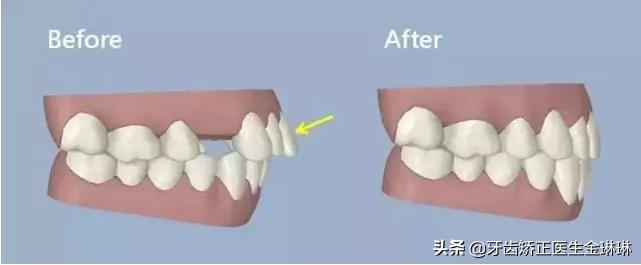 矫正牙齿期间可以去其他店补牙吗,淄博矫正牙齿一般多少钱