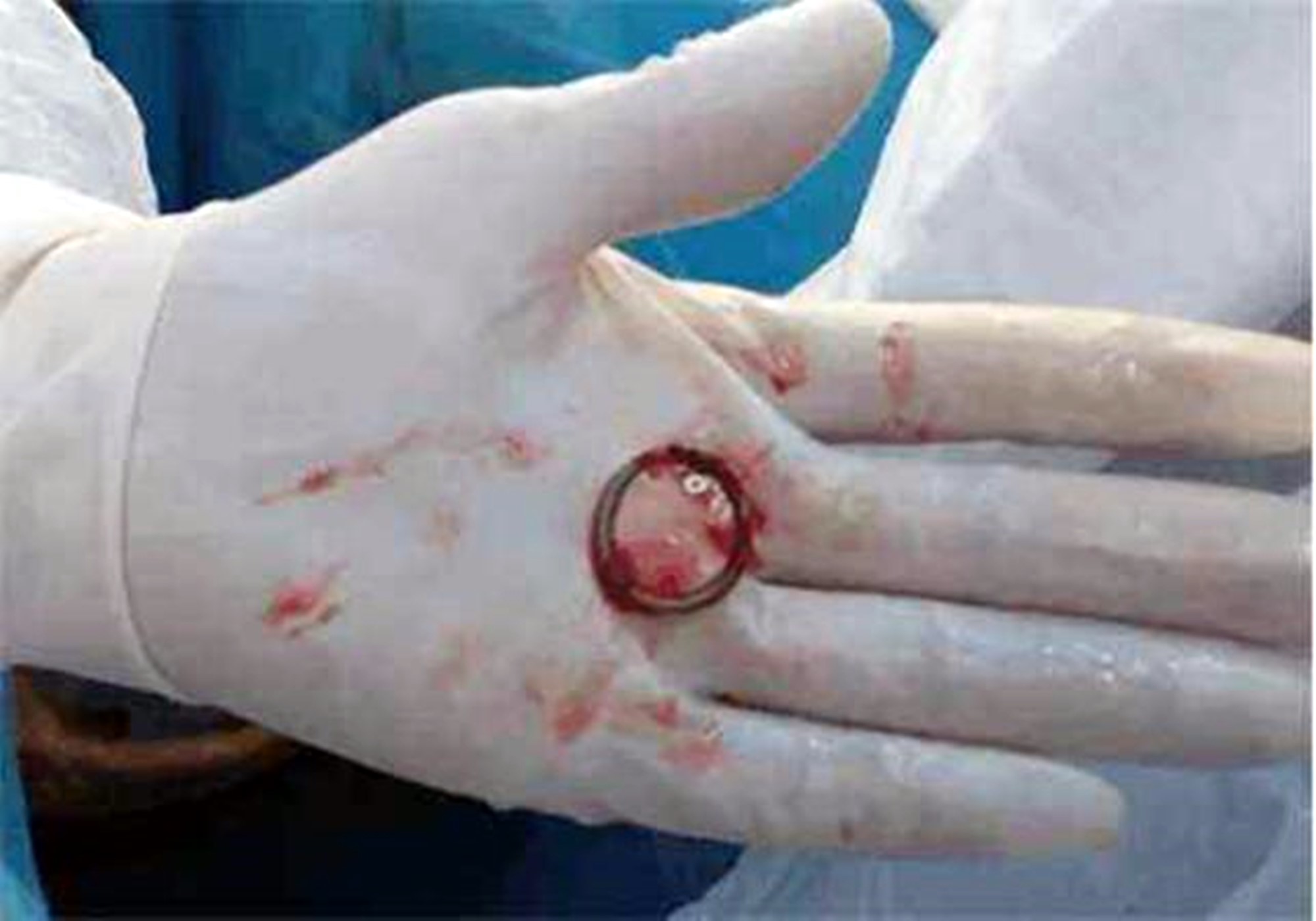 上环妈妈取环,几十年前女性上环