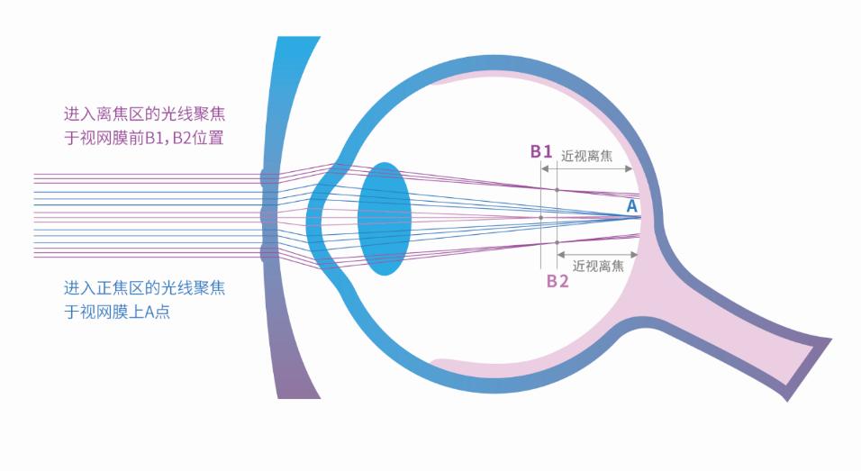 10岁的孩子近视后来怎么样了,一位母亲的自白