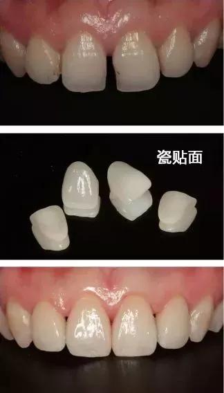 医生补的牙缝大怎么办,牙缝越来越大了医院可以治疗么