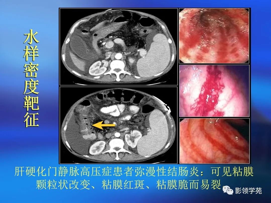 肠道内壁增厚,肠道扩张ct表现