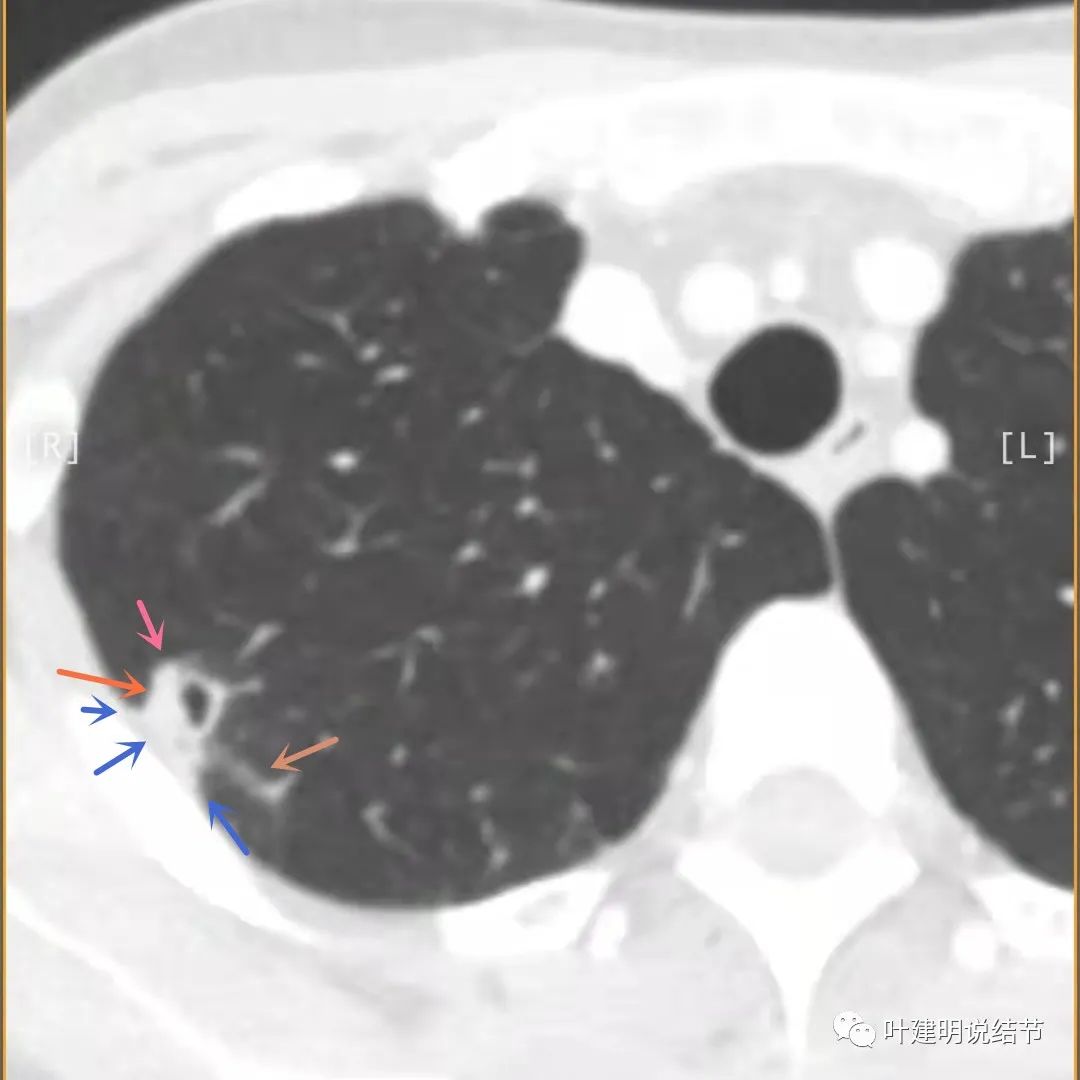 临床诊断孤立性肺结节,空洞型结节一般是什么性质