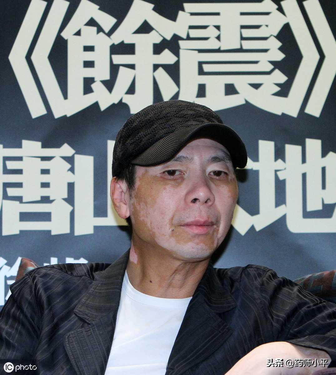 长白斑是白癜风吗,长白癜风