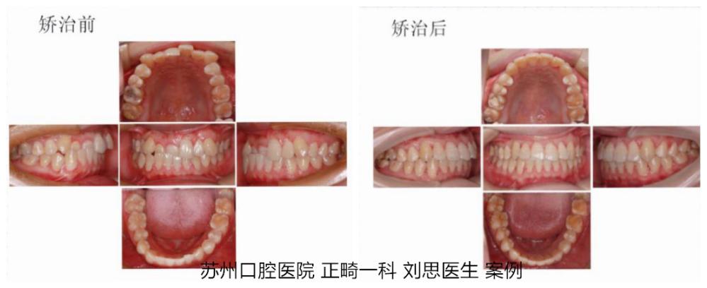 成人矫正期间牙齿松动正常吗,成年人牙齿矫正会松动吗
