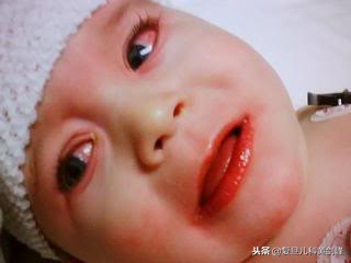 发热白细胞高单核细胞高,发热白细胞高达25什么原因