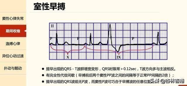 室早患者注意事项,室早严重会对身体有多大影响