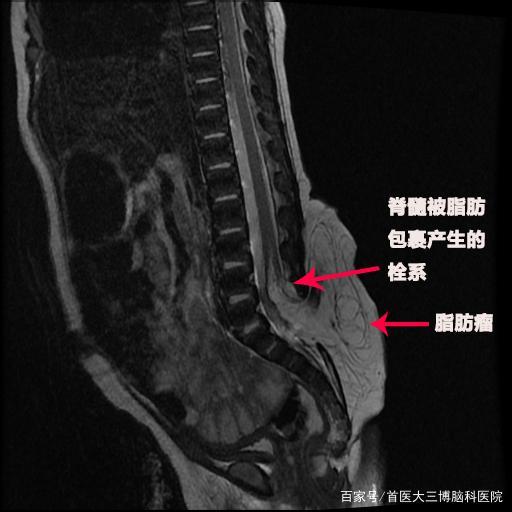 宝宝尾骨处有个小坑一般多大长好,宝宝尾巴骨出了好多小疙瘩