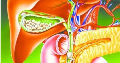 又有胃病又有胆结石怎样注意饮食,胆结石引起的胰腺炎饮食注意什么