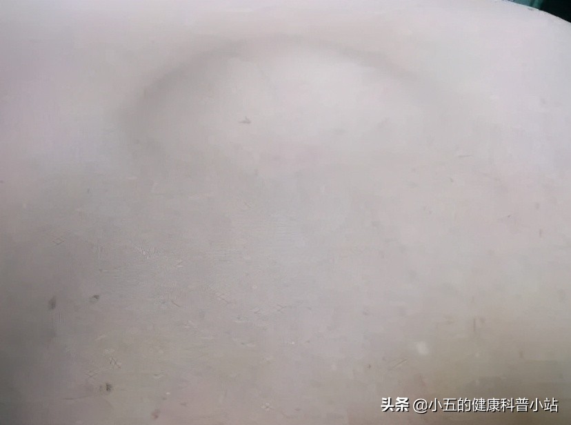 什么叫做脂肪瘤该怎么医治,脂肪瘤有什么危害脂肪瘤最怕什么