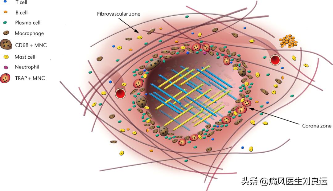 抗生素会引起痛风急性期发作吗,抗生素治风湿吗