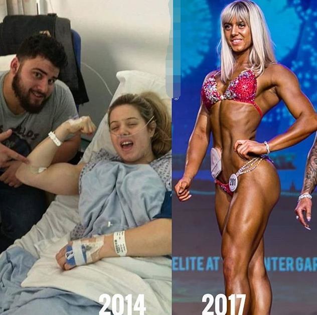 造口患者的心理,造口人真的存在心理障碍吗