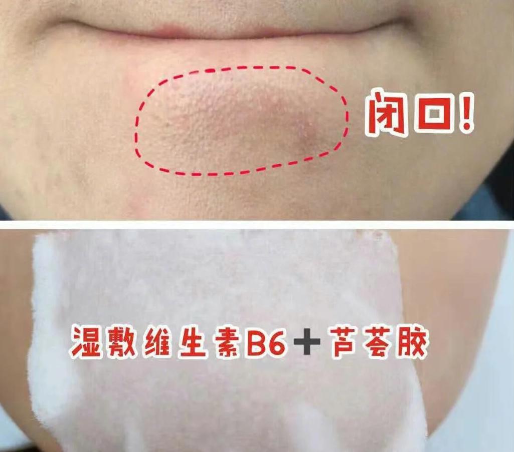 四个亲测有效的祛痘小妙招，坚持一个星期，不用花钱就有好皮肤