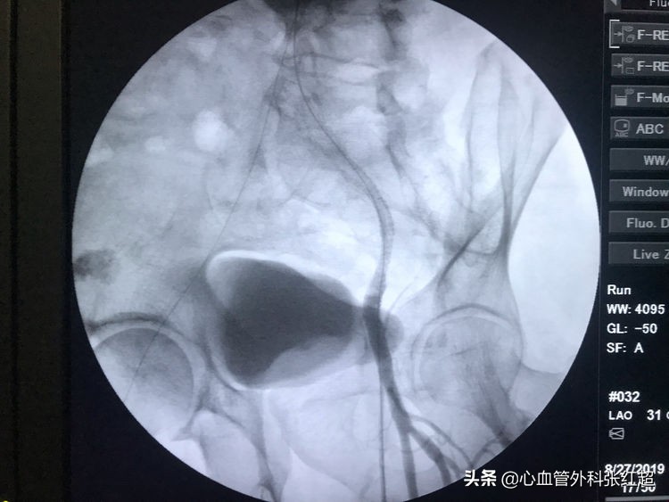 外周血管外科治疗范围,外周血管介入治疗疗程