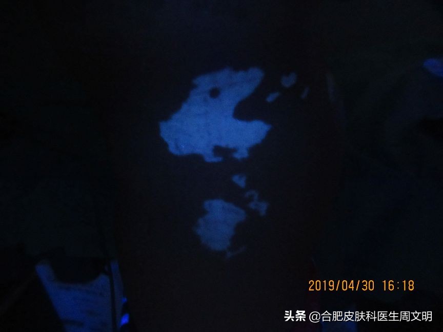 15岁女生误诊,15岁女孩染病竟有4年病史