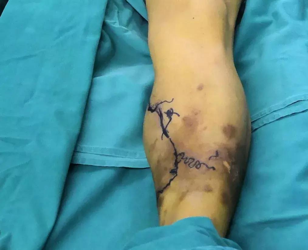 小针孔,小针眼最佳治疗方法