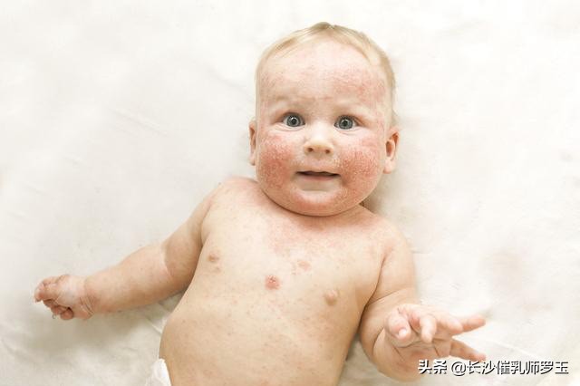 宝宝低烧过后身上起小红点,40天宝宝身上起小红点