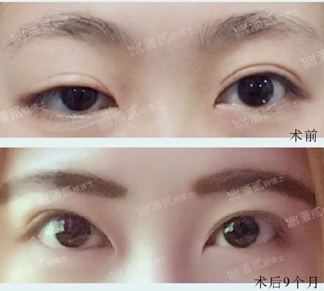 双眼皮术后恢复不一致正常吗,双眼皮术后看着不对称