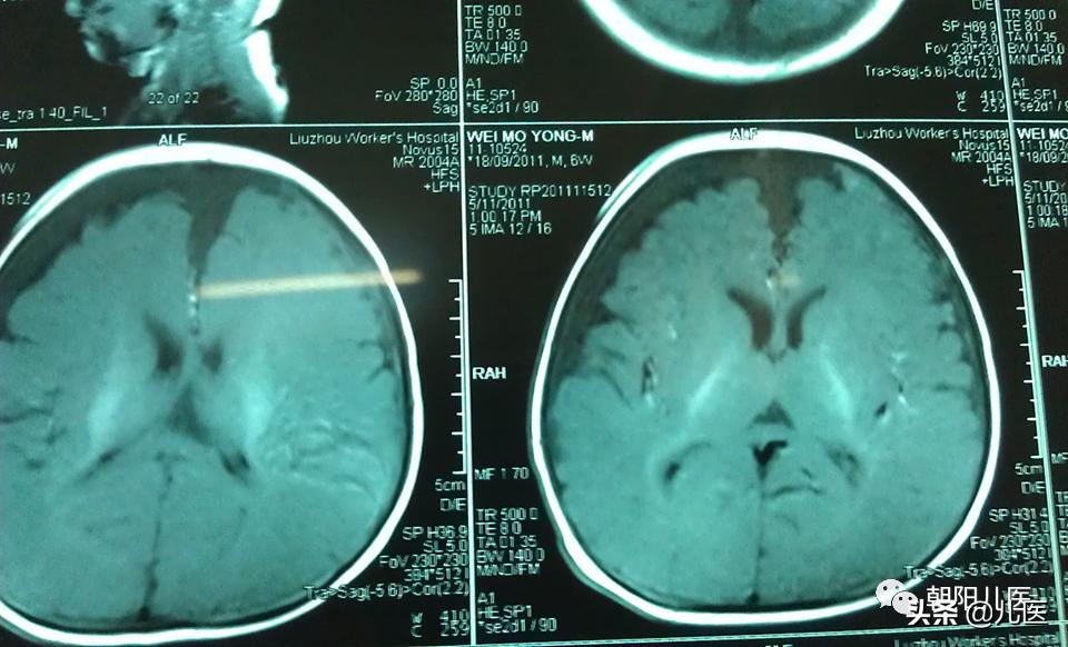 要是不打疫苗有事吗,不打疫苗对住院有影响么