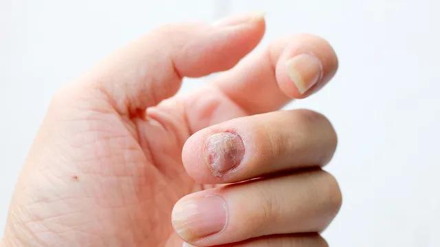 什么药膏能彻底把灰指甲治好,想治好灰指甲非要吃药吗