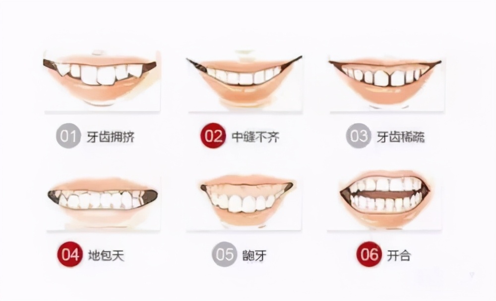 13岁儿童牙齿矫正龅牙前突,牙齿前突龅牙治疗过程