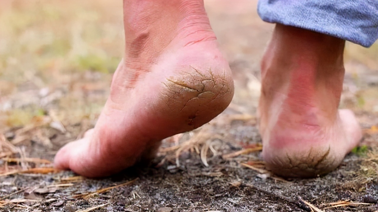 脚后跟开裂缺少哪种维生素,脚后跟干裂起皮是缺乏什么