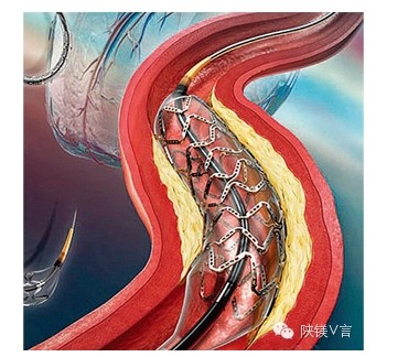 为什么说不锈钢可以植入人体,造福人类发明了什么