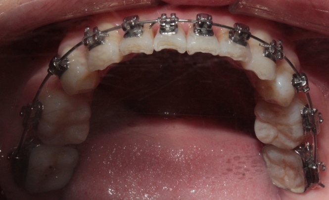 南京牙齿矫正内倾,南京牙齿矫正比较好的医院有哪些