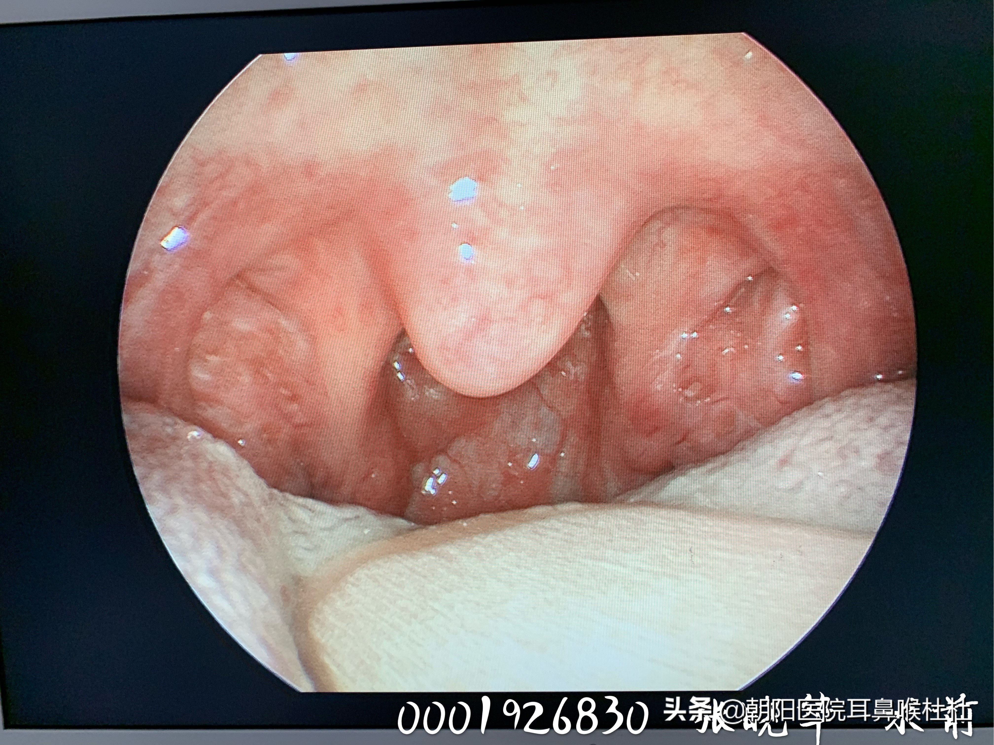别拿扁桃体发炎不当回事