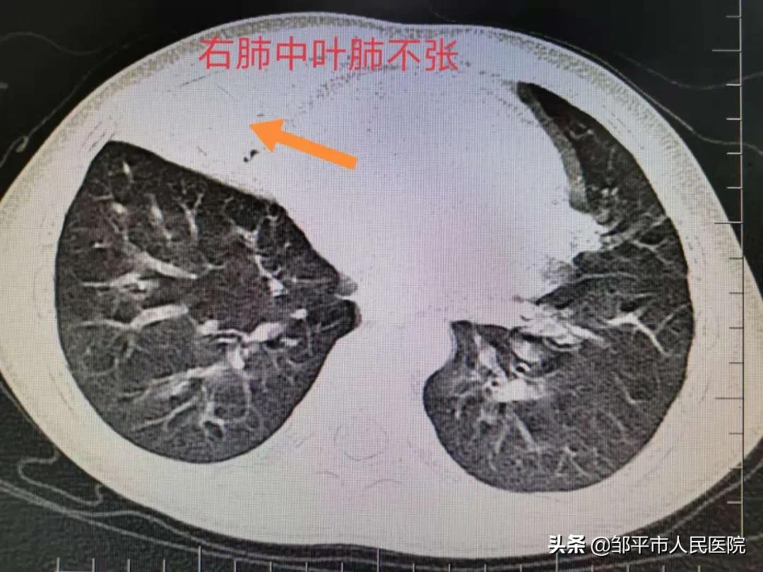 重症肺炎最佳治疗方法,满月宝宝重症肺炎如何治疗