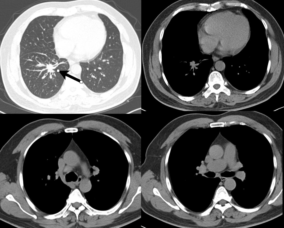 分享一个肺癌脑转移病例