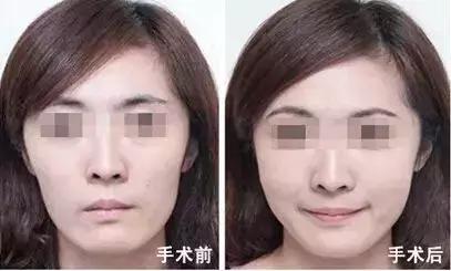 线雕加玻尿酸可以保多长时间,玻尿酸加线雕隆鼻能半永久吗