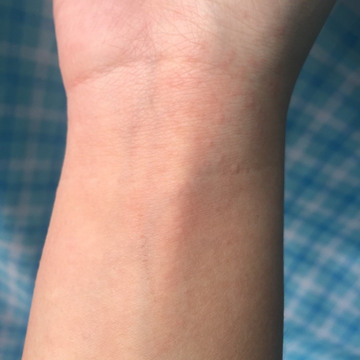 崩溃了，明明很小心了，怎么总过敏