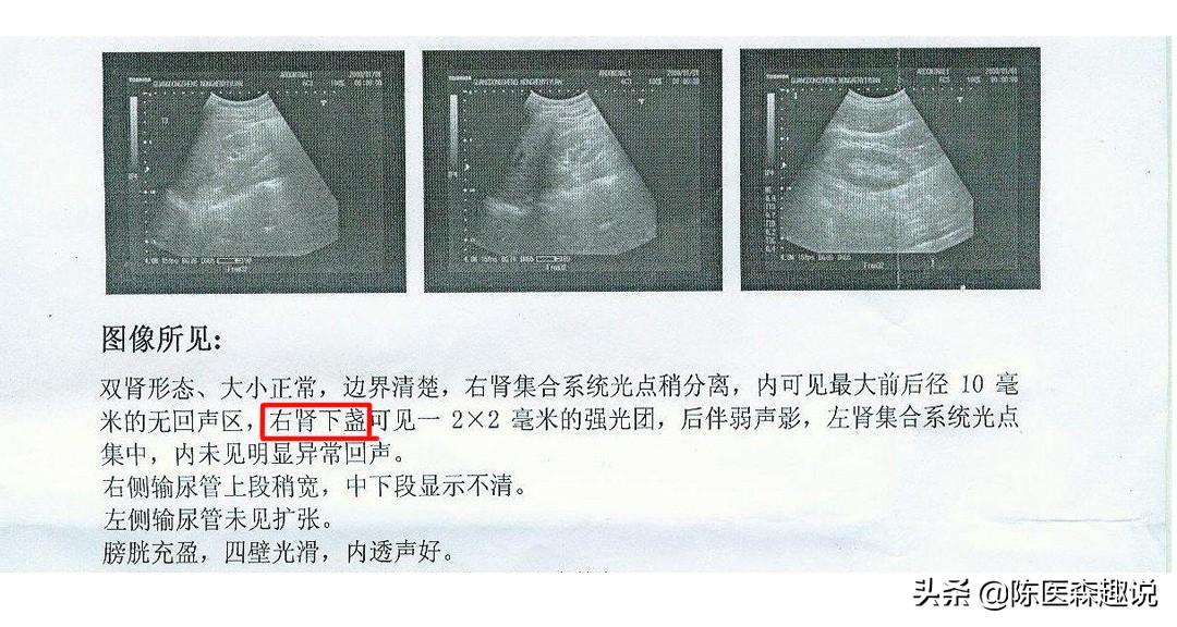 1.5厘米的肾结石保守治疗能排石吗,肾结石快速排石方法