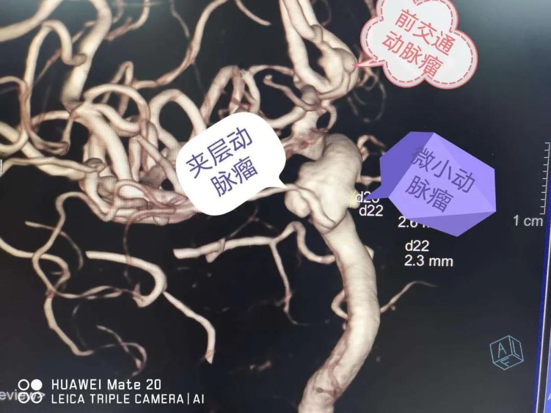 惊心动魄的心血管介入手术,脑动脉瘤开颅的全过程实例