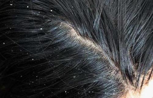 头顶出油发尾干燥怎么办,头发头顶油发梢干怎么办