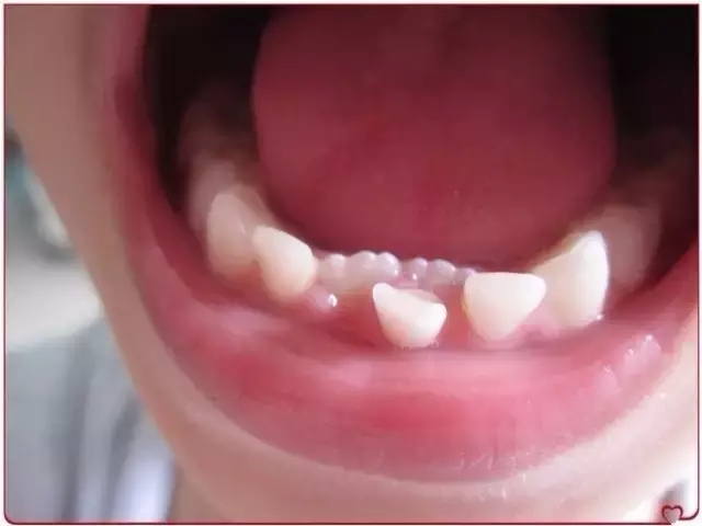 双层牙如何矫正位置,面对金口难开的家长该怎么沟通