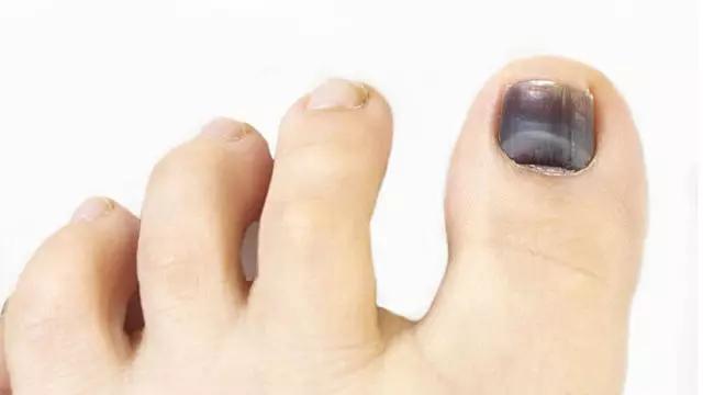跑步跑出黑指甲怎么处理,跑步脚上出现黑趾甲该怎么处理