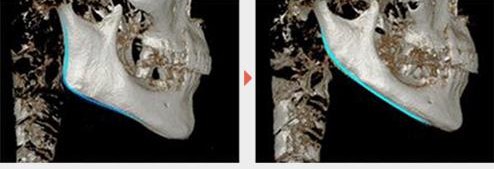 华晨宇的下巴,削下颌骨的华晨宇